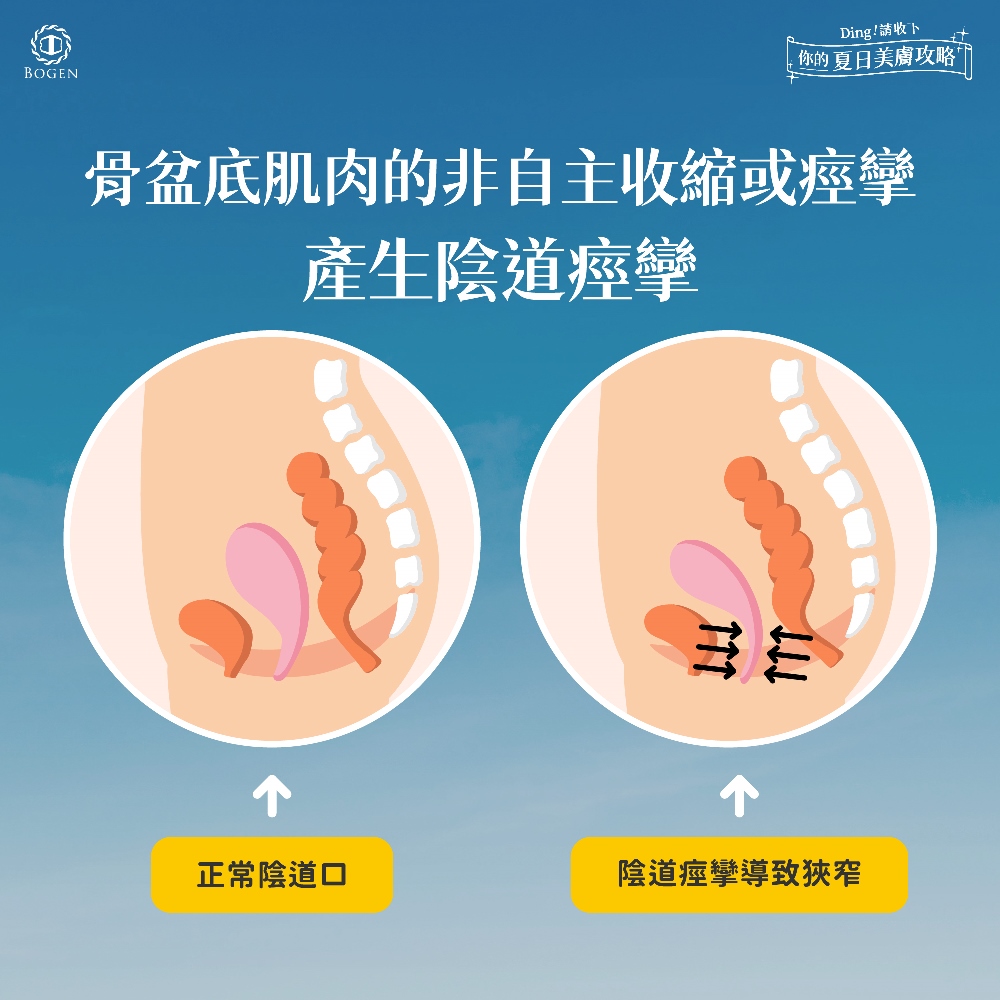 私密處手術推薦陰道痙攣,推薦宋承嬡醫師,博恩妍